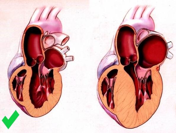 Cardione novērš sirds kambaru hipertrofiju